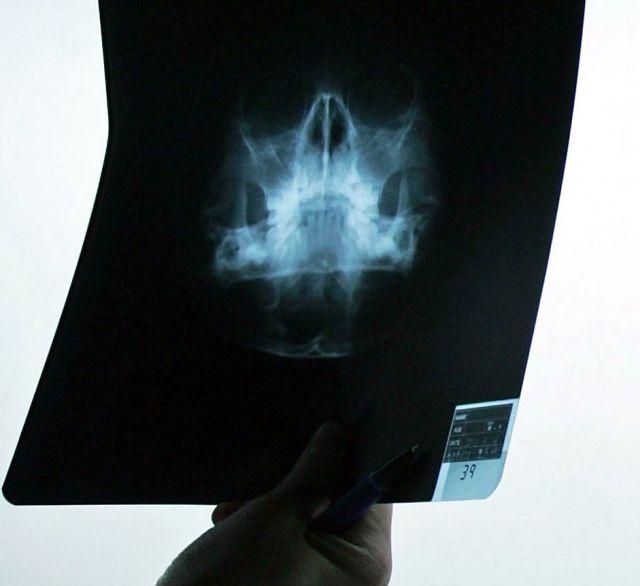 Kada telo napadne mozak: Važno otkriće o uzroku encefalitisa